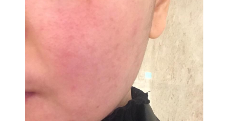 脸过敏可以擦防晒霜吗