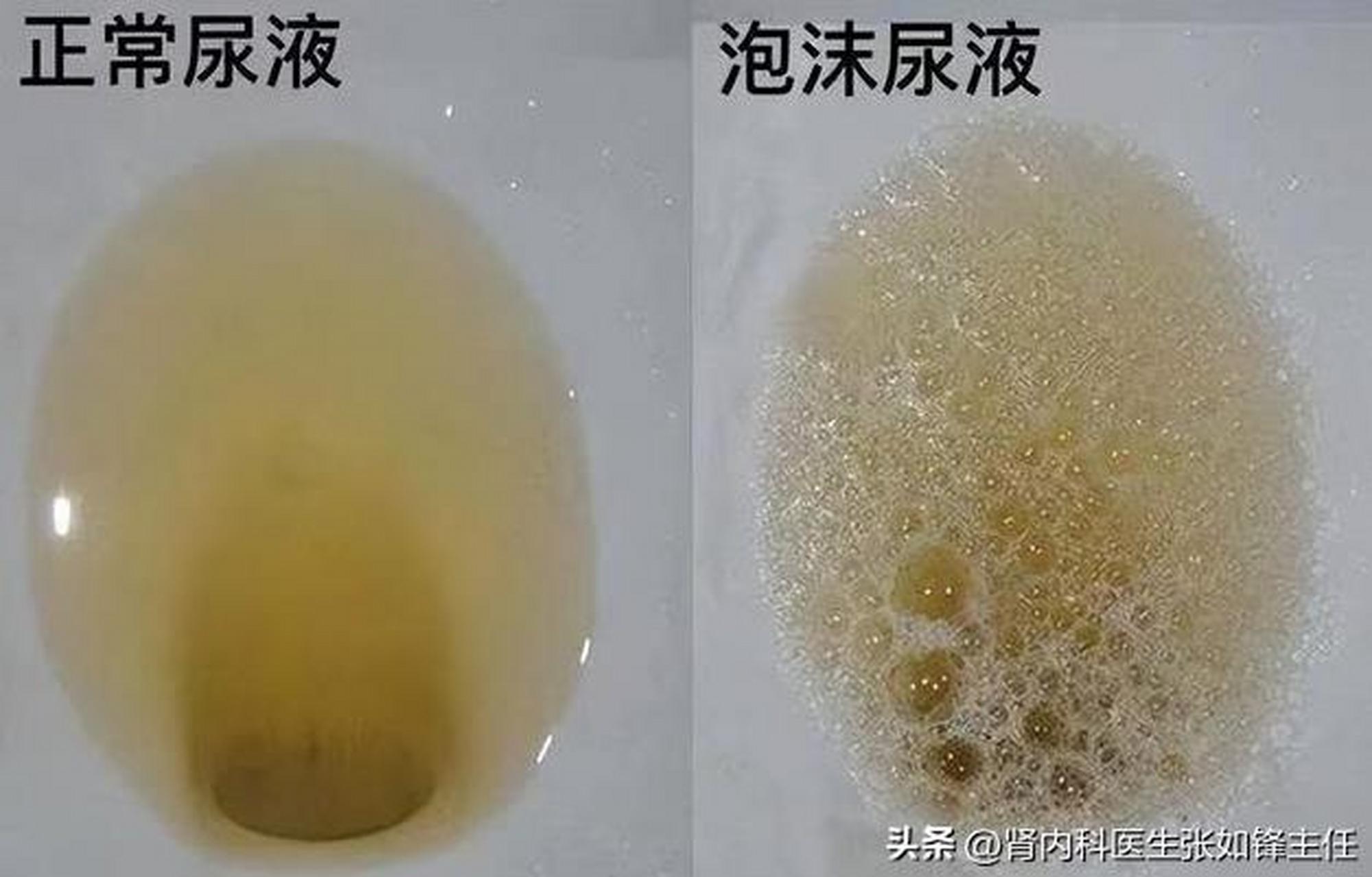 糖友出现泡沫尿要当心肾脏损害,那么什么样的泡沫尿要重视起来呢?