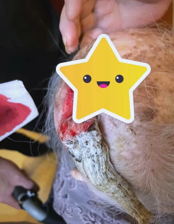 90岁老奶奶"头上长角"引发皮角警惕与癌前预警