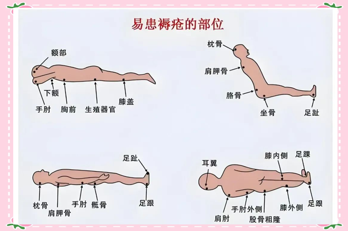 健康科普揭秘:压疮如何影响我们的健康?