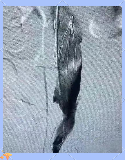 深入了解下腔静脉滤器植入术及其应用