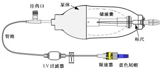 便携式化疗泵化疗,你知道多少?