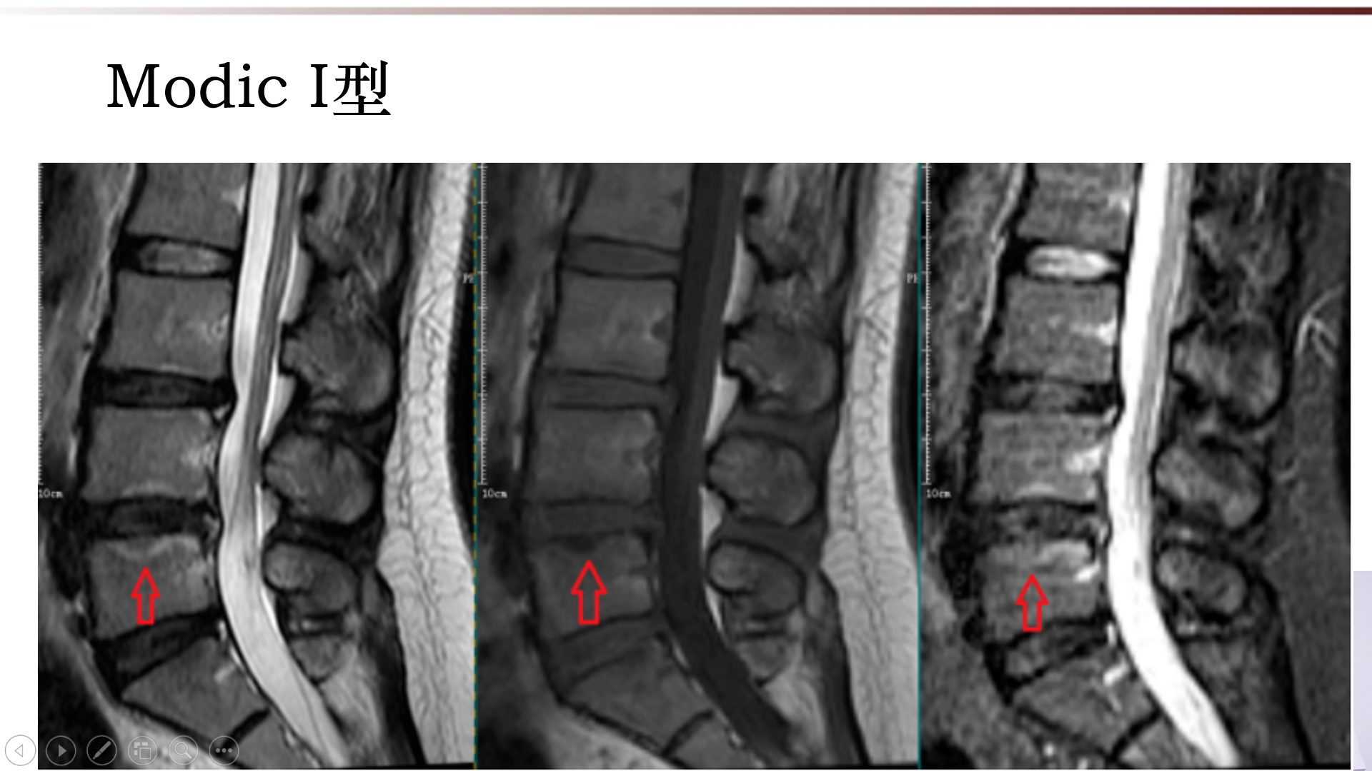 终板造瘘图片