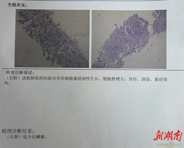 肺癌活检报告图片