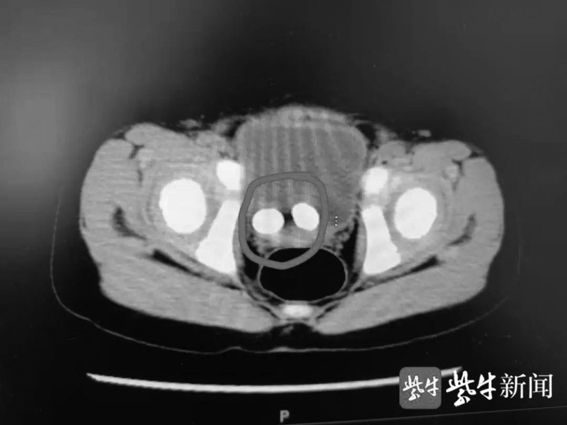 4歲男童膀胱,輸尿管里長出2個大結石 竟是因為這個壞習慣