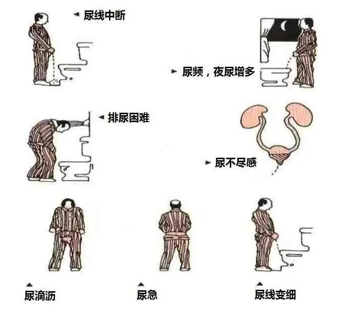 女性尿频尿急 方法图片