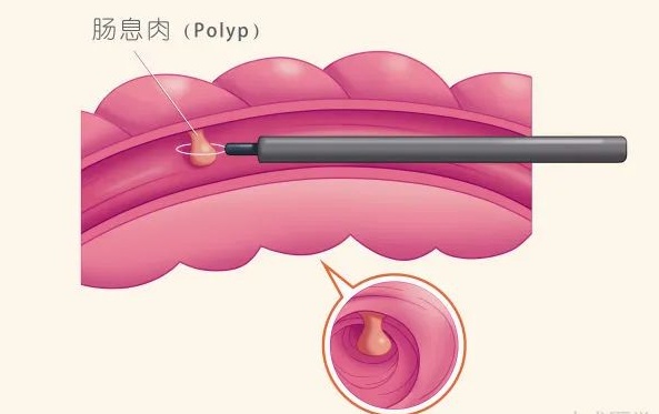 【健康促进主题日】世界肠道健康日——健康"肠"相伴,大肠息肉不要怕
