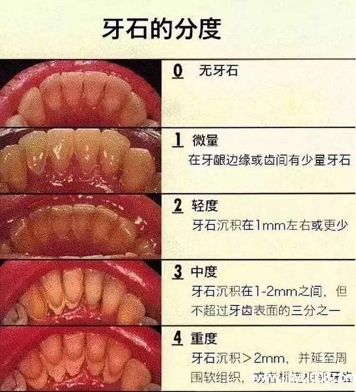 牙结石的危害图片