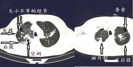 肺结核ct图片图解图片