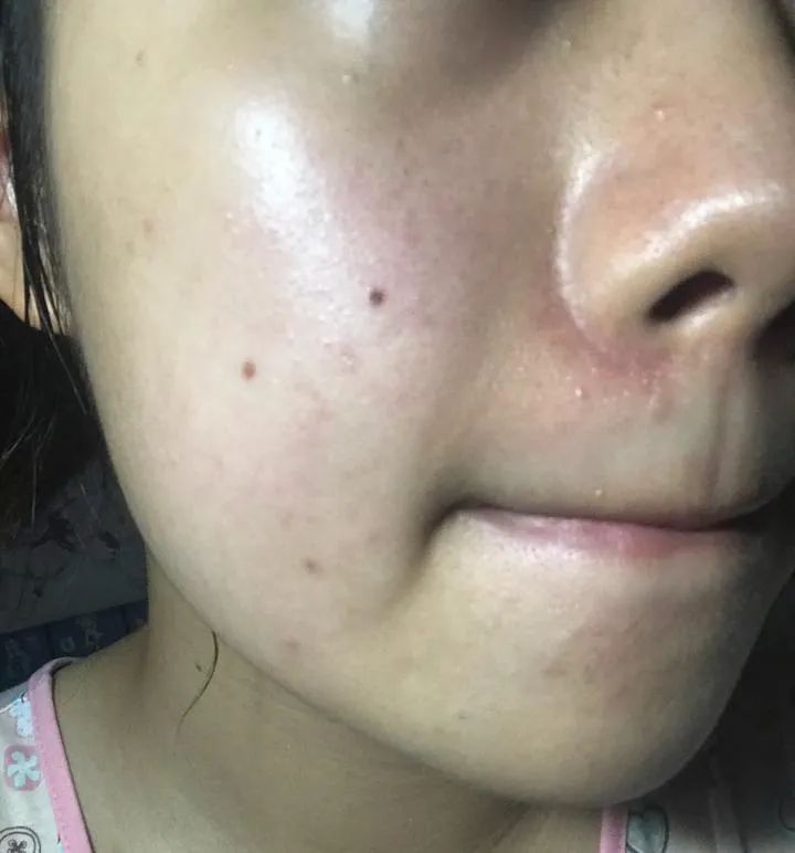 脸上爱出油,鼻翼泛红,脂溢性皮炎你中招了吗?
