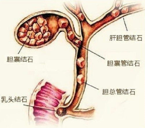 急性胆囊炎图片图片