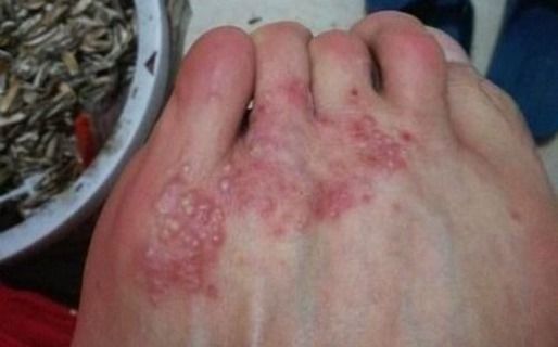 脚部瘙痒,起水泡真的是脚气吗?