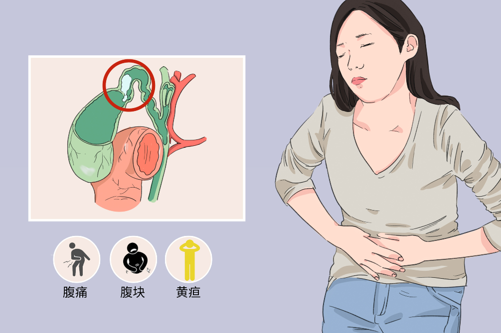 胆囊结石临床表现图片