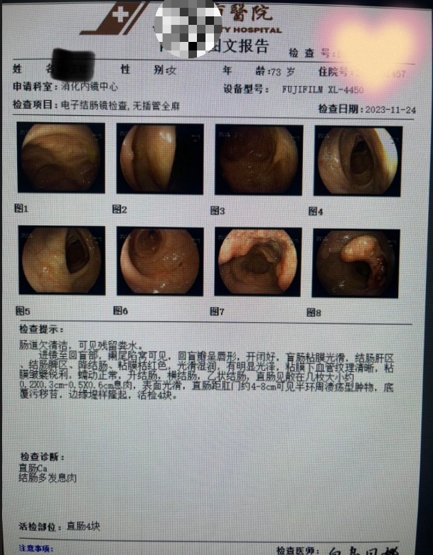 73岁高龄女性因大便次数增多伴不成形查出直肠癌