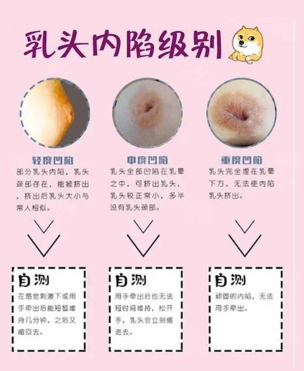 女性乳房凹陷图片