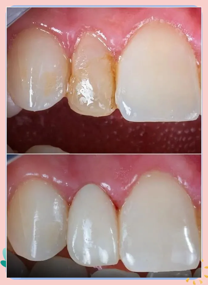 全面了解马里兰桥:掌握其应用与优缺点