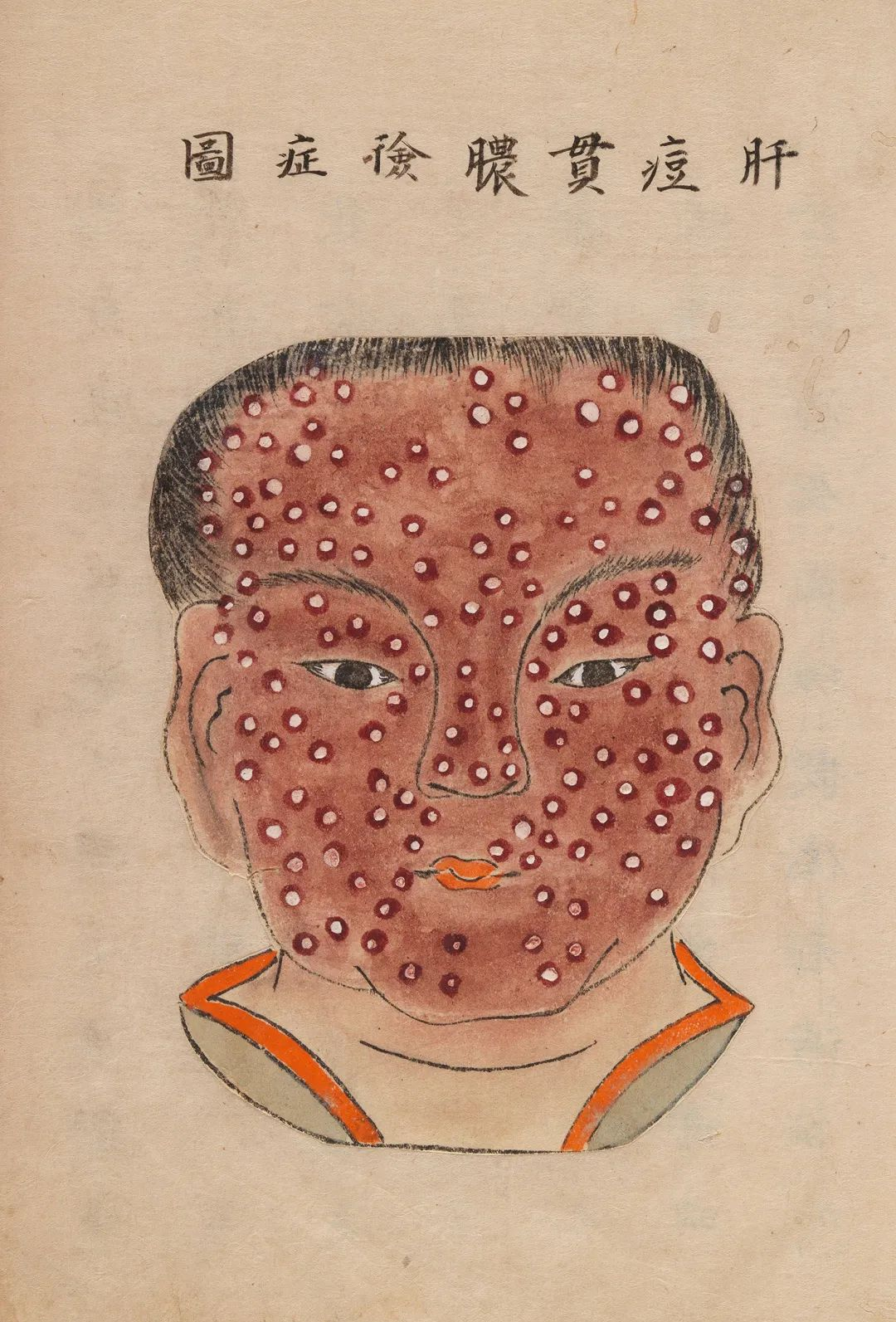 多种痘疹图片集:天花与疱疹的多样形态