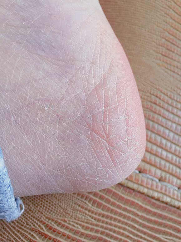 36岁,脚跟干裂有死皮,快2年了,怎么办?