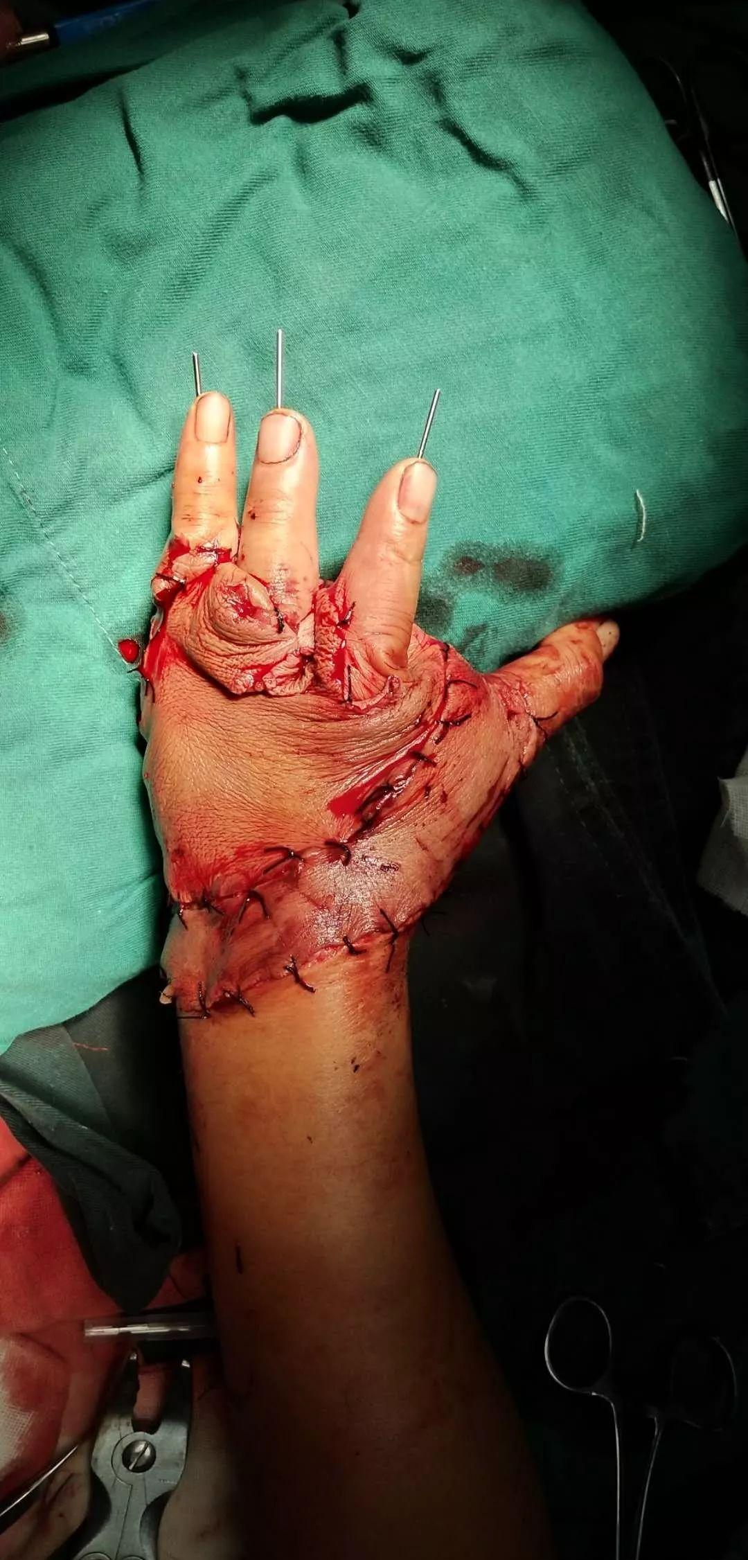 严重手外伤的救治案例