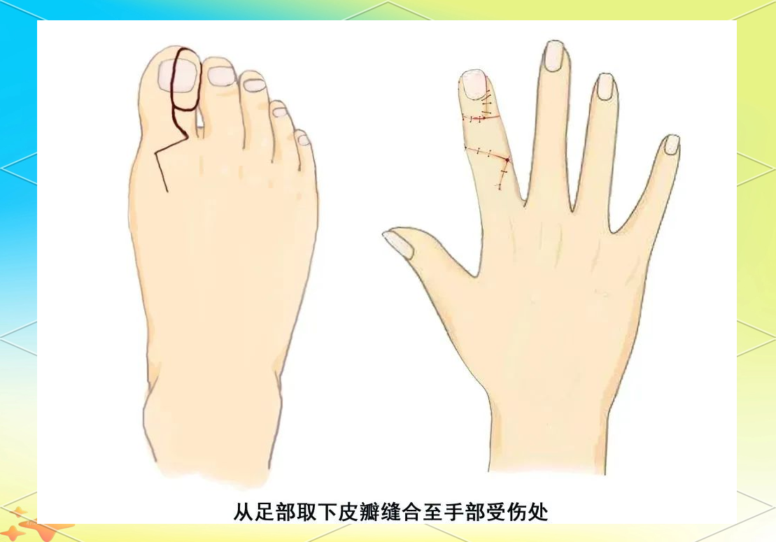 一种独特的手指修复技术