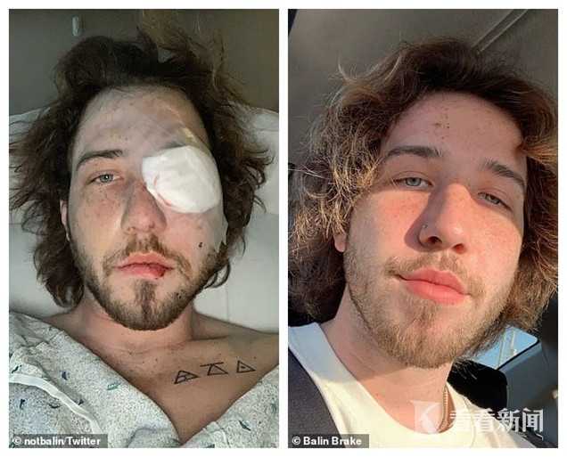 白人男子被催泪弹打瞎一只眼:这点痛相比不算啥