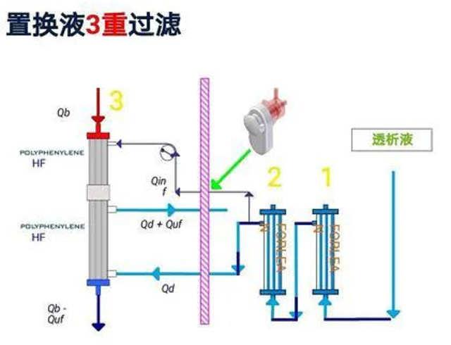 守住患者生命线——中铁阜阳医院开展血液透析滤过新技术