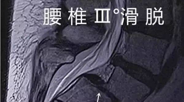 腰椎滑脱程度的分级图解