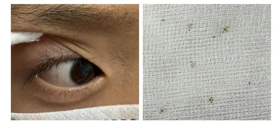 福州4岁男童睫毛上捉下5只活虫,竟然是阴虱!