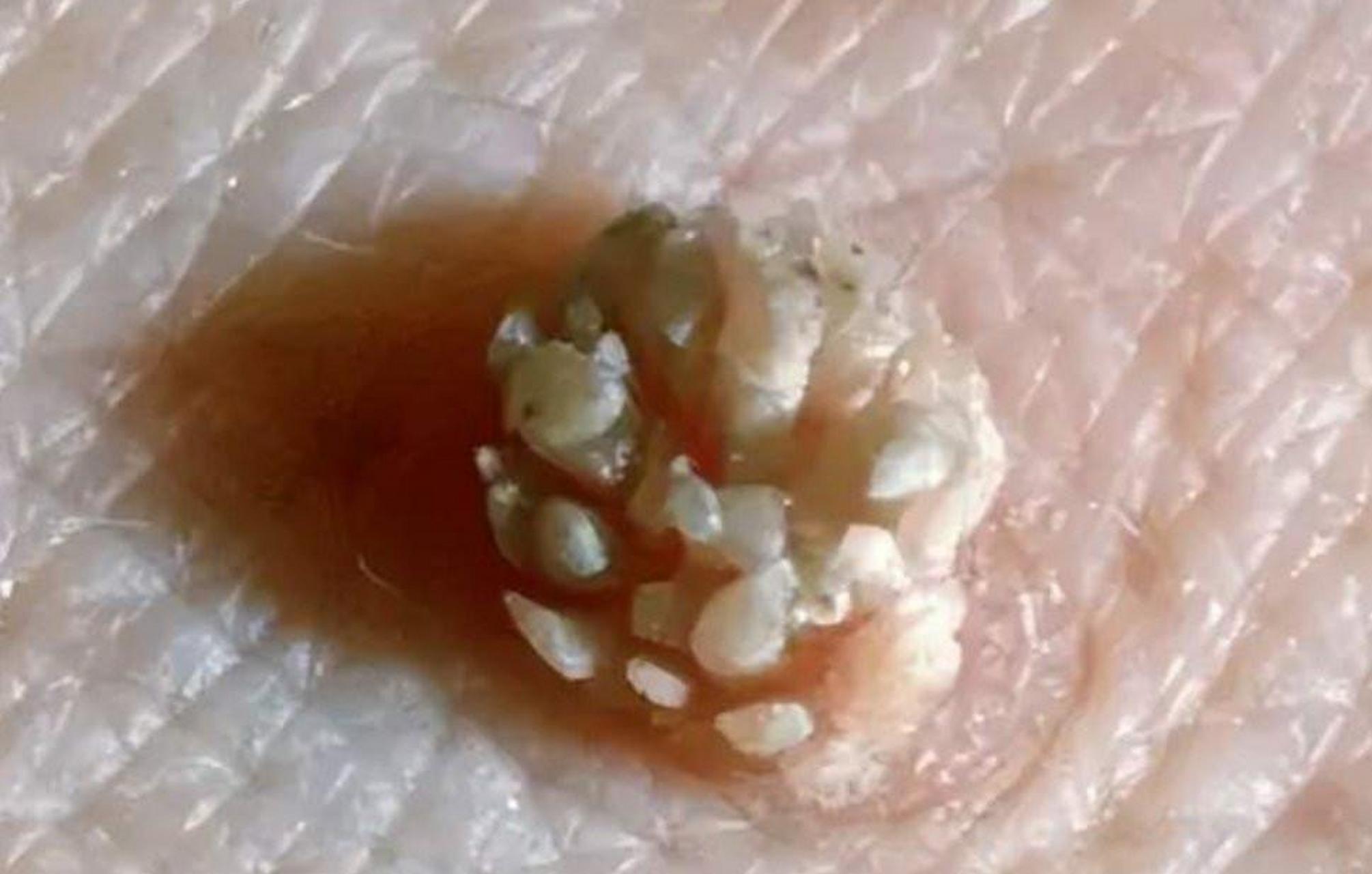 男童喉咙长菜花样肿块确诊感染hpv#  hpv简称人乳头瘤病毒,自然界中