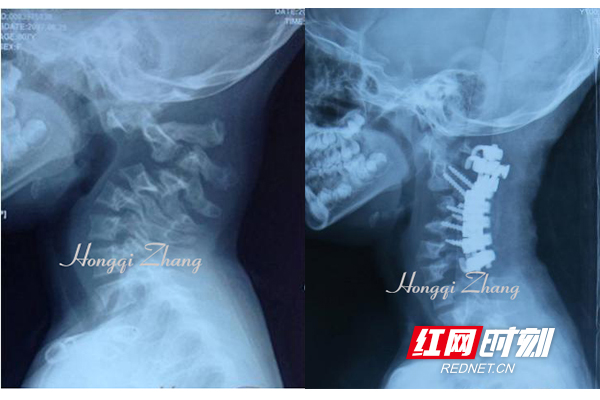 女子颈椎严重反曲畸形 湘雅专家助其脱离瘫痪危机