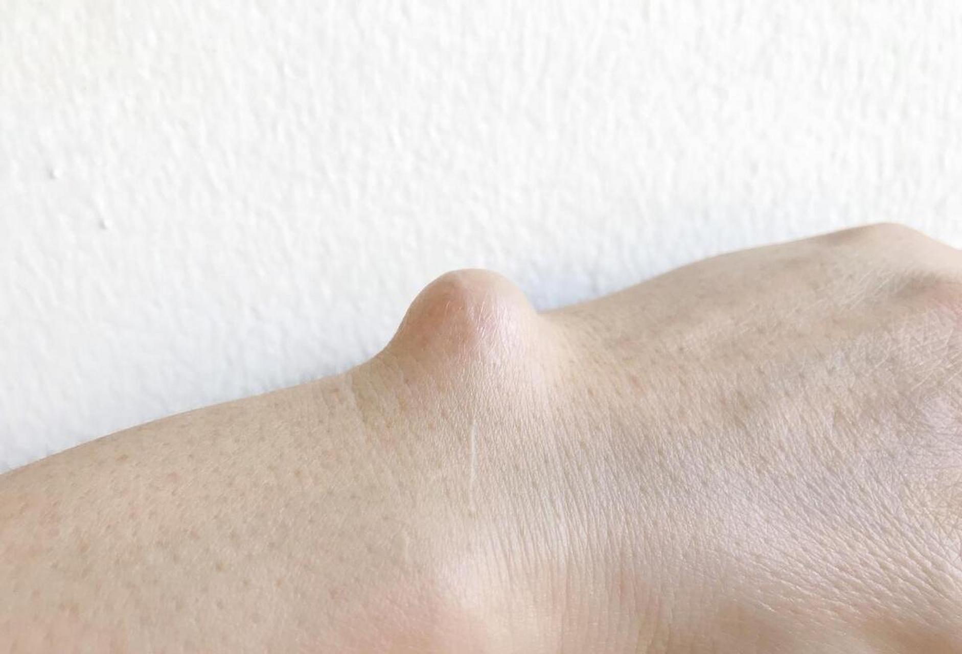 脂肪瘤,现代人身上常见的瘤体,又叫"小肉疙瘩","小肉瘤",是一团团边界