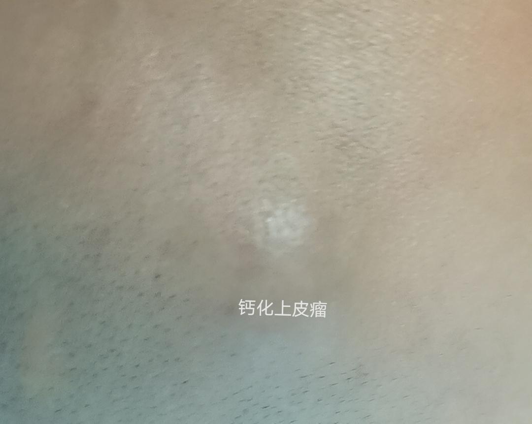 皮肤科:宝宝脸上突然出现肿块,小心这种瘤!