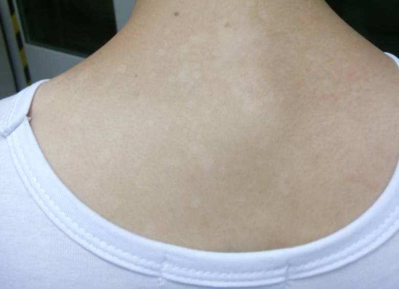注意:夏季白斑≠白癜风,别把汗斑错当白癜风
