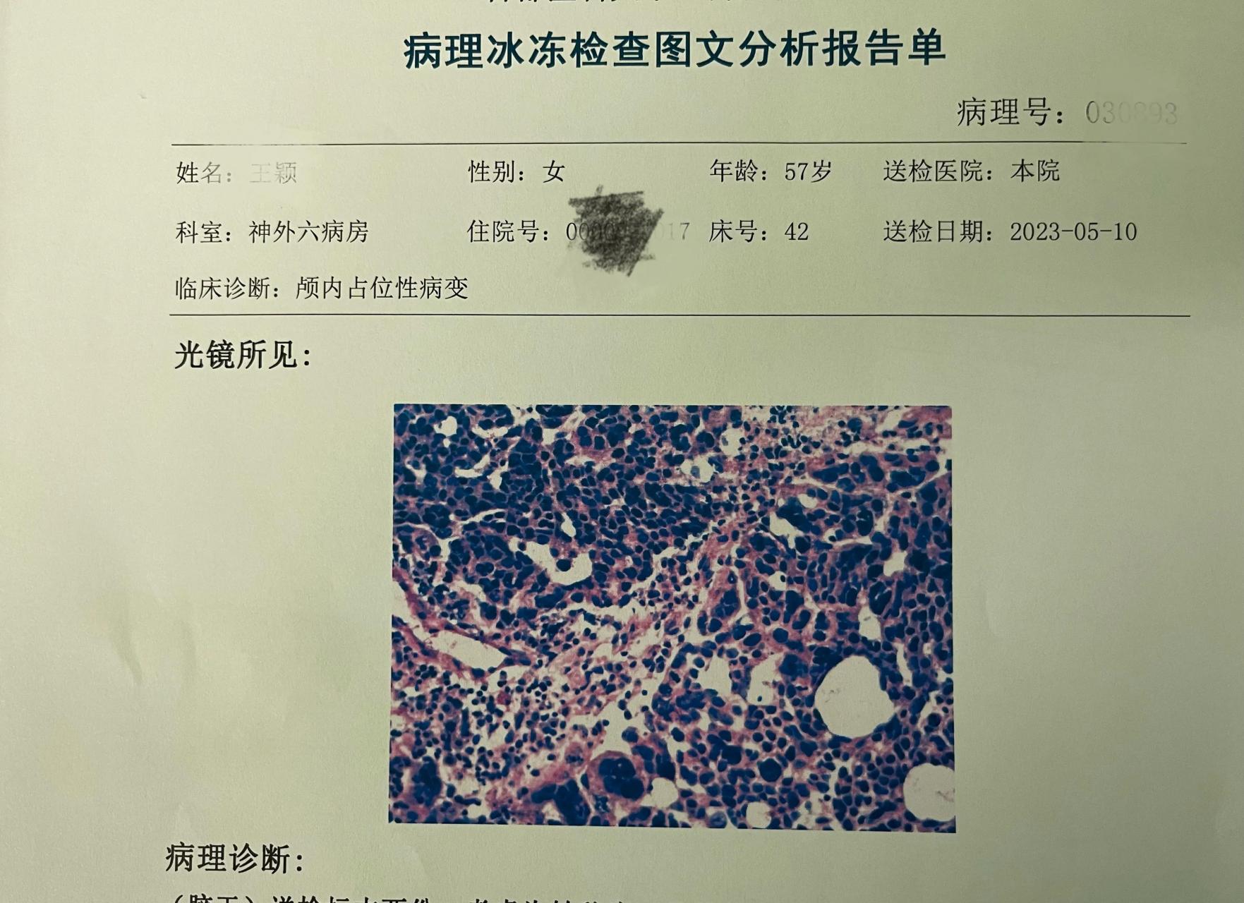 胶质瘤病理报告图片