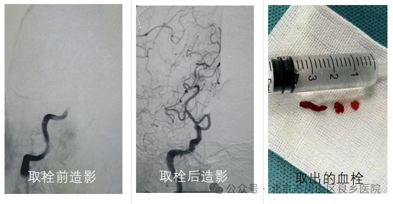 脑动脉瘤介入栓塞术图图片