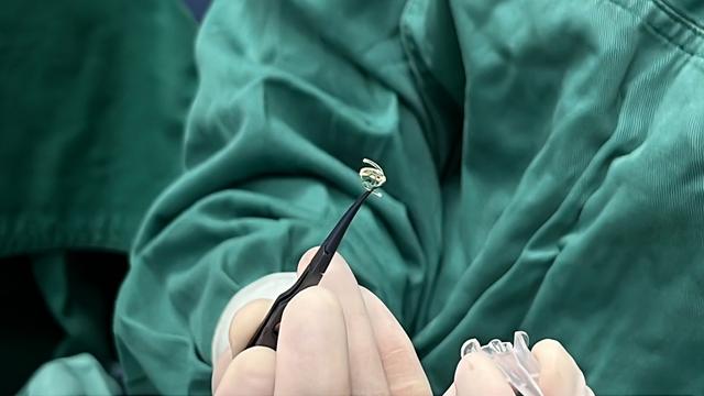 全国首批强生tecnis synergy64人工晶状体在贵阳爱尔完成植入