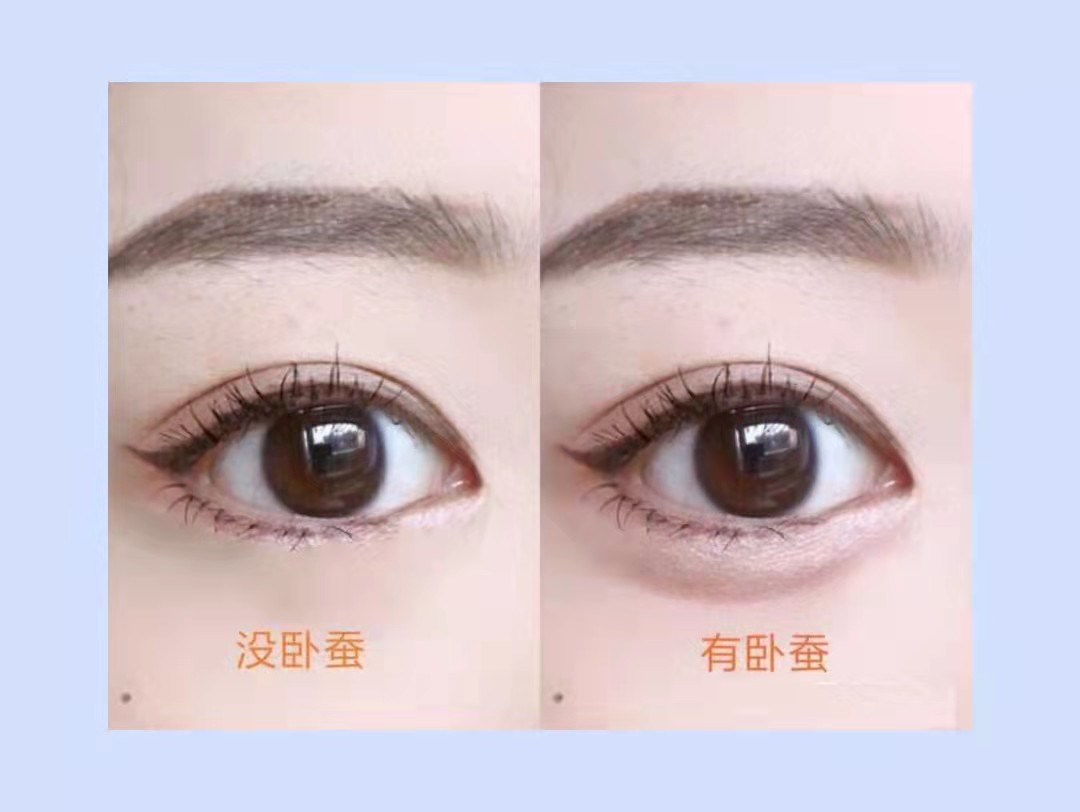 眼袋术后并发症严重?修复应注意这两点!