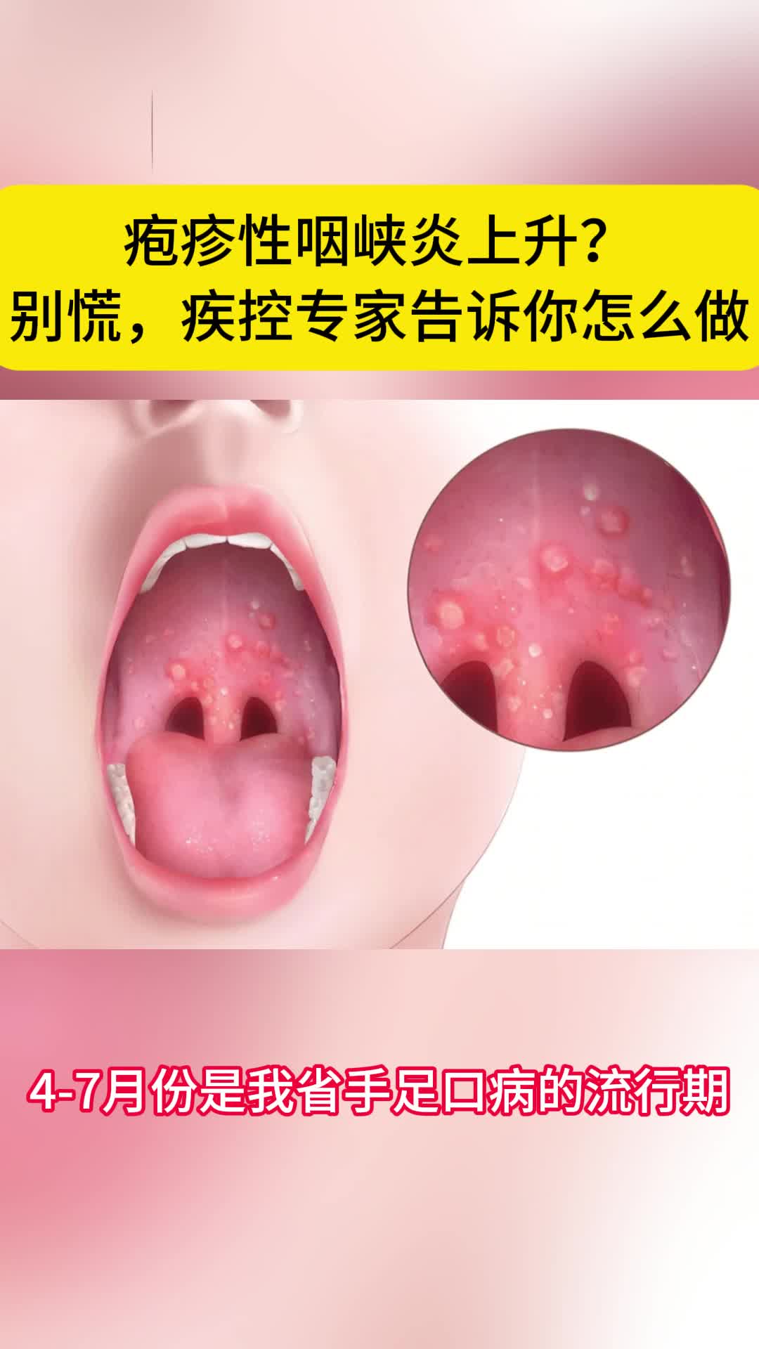 疱疹性咽峡炎上升?别慌,湖南省疾控专家告诉你怎么做