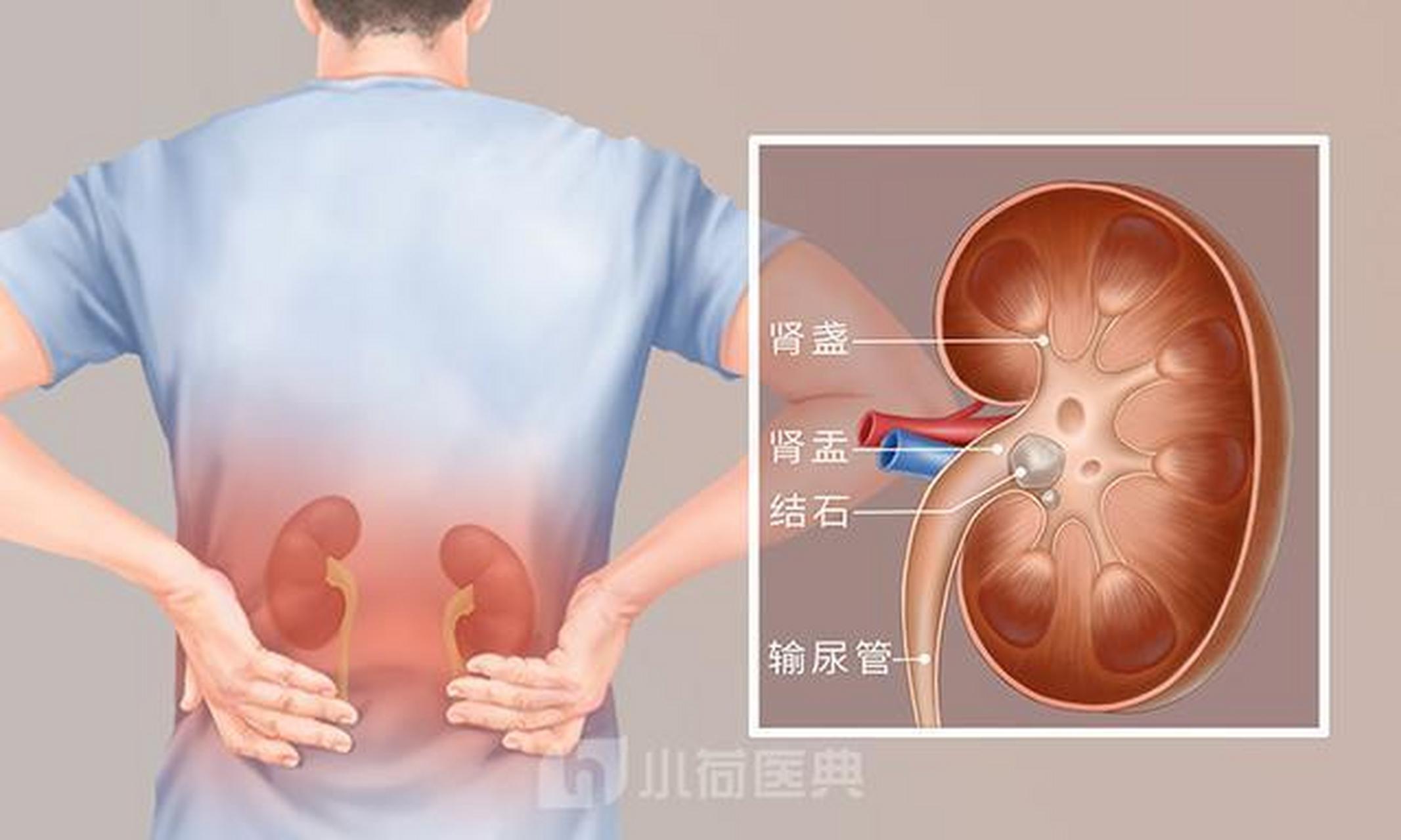 肾结石疼痛部位图片图片