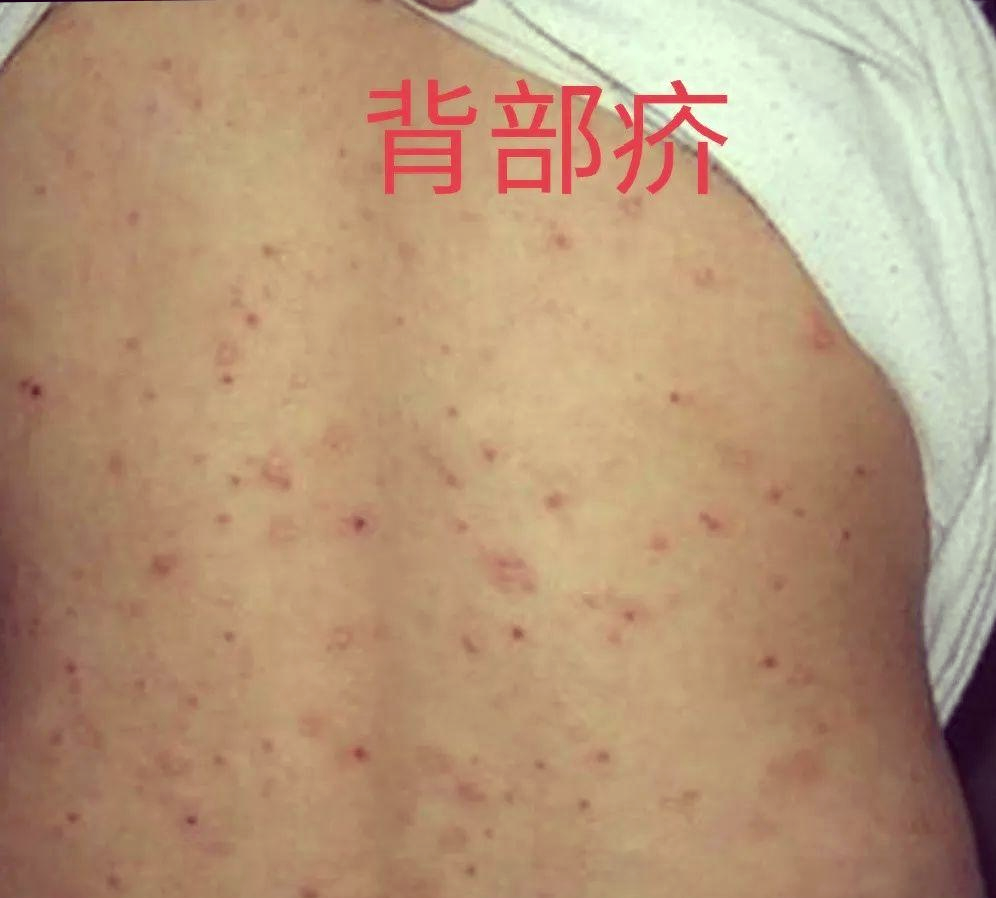 疥疮的困扰与防治方法