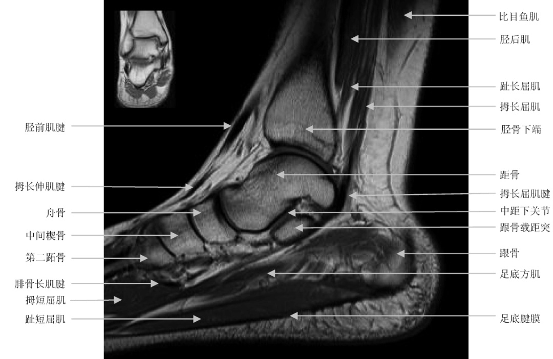小腿mri解剖图图片