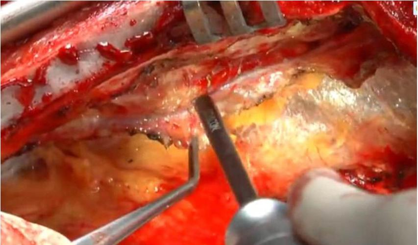 微创心脏搭桥术:77岁老人的新生之路