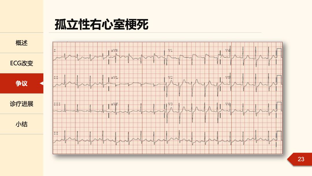 老生常谈丨右心室梗死的心电图诊断?