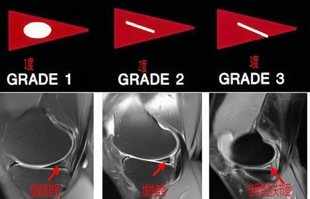 半月板损伤自我判断图图片