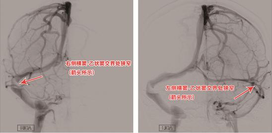 莫名头痛伴视力模糊病因竟是静脉窦狭窄 支架置入"天堑变通途"