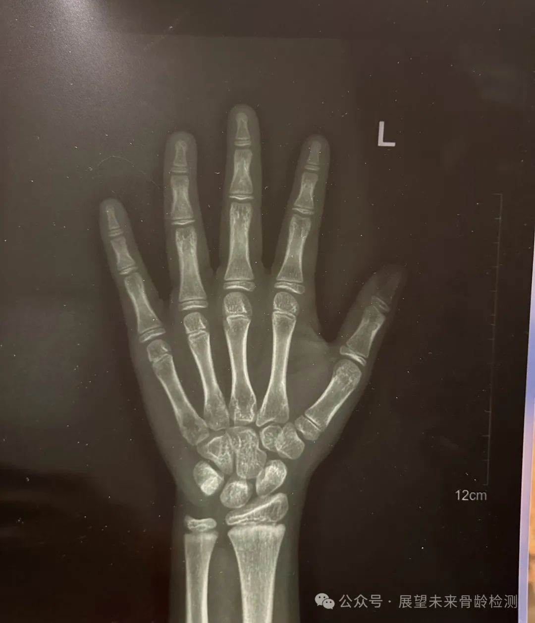 孩子测骨龄 籽骨出现代表什么?