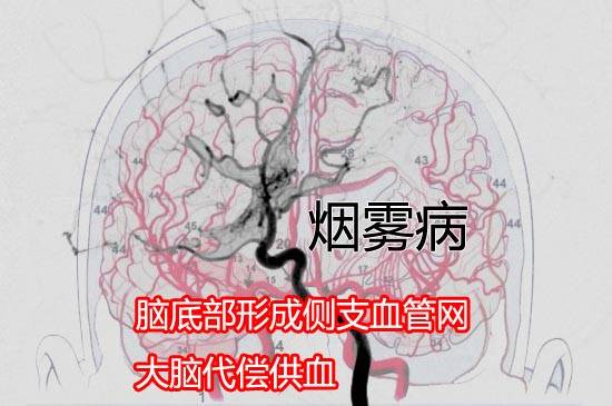 烟雾病是什么病（烟雾病是什么病有什么症状）-第2张图片-潮百科