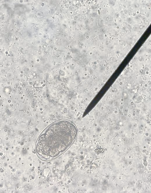 广西医院如何分辨真假"元凶"钩虫卵