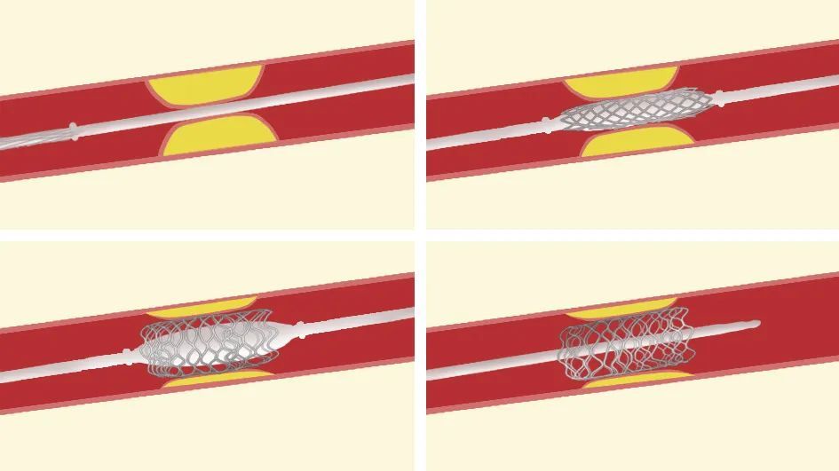 脑血管支架置入术后的"那些事"