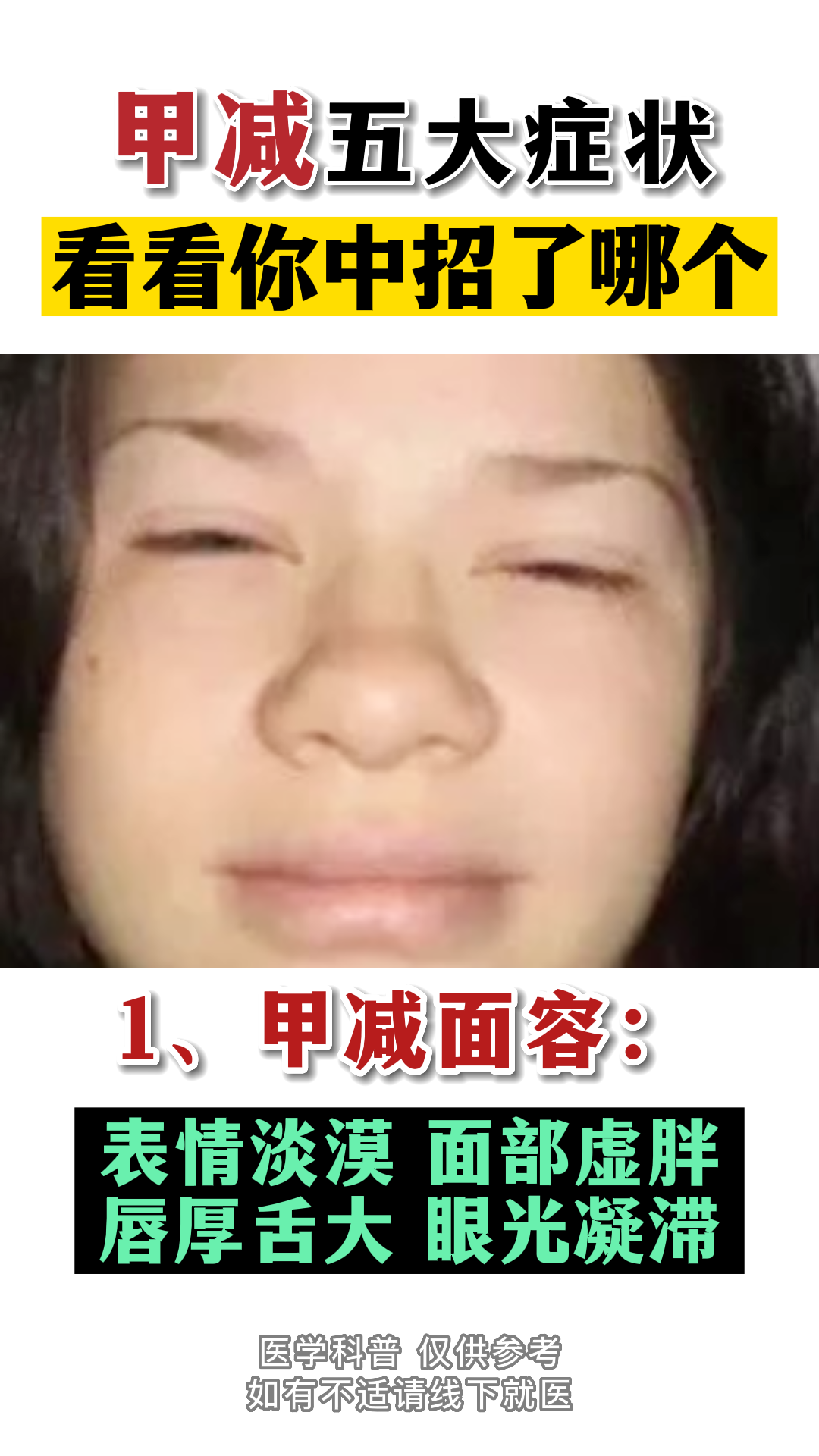 新生儿甲减面容图片图片